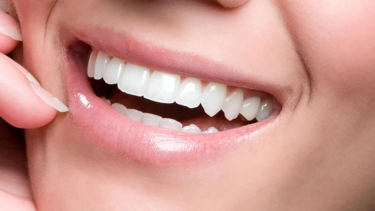 Après blanchiment dentaire