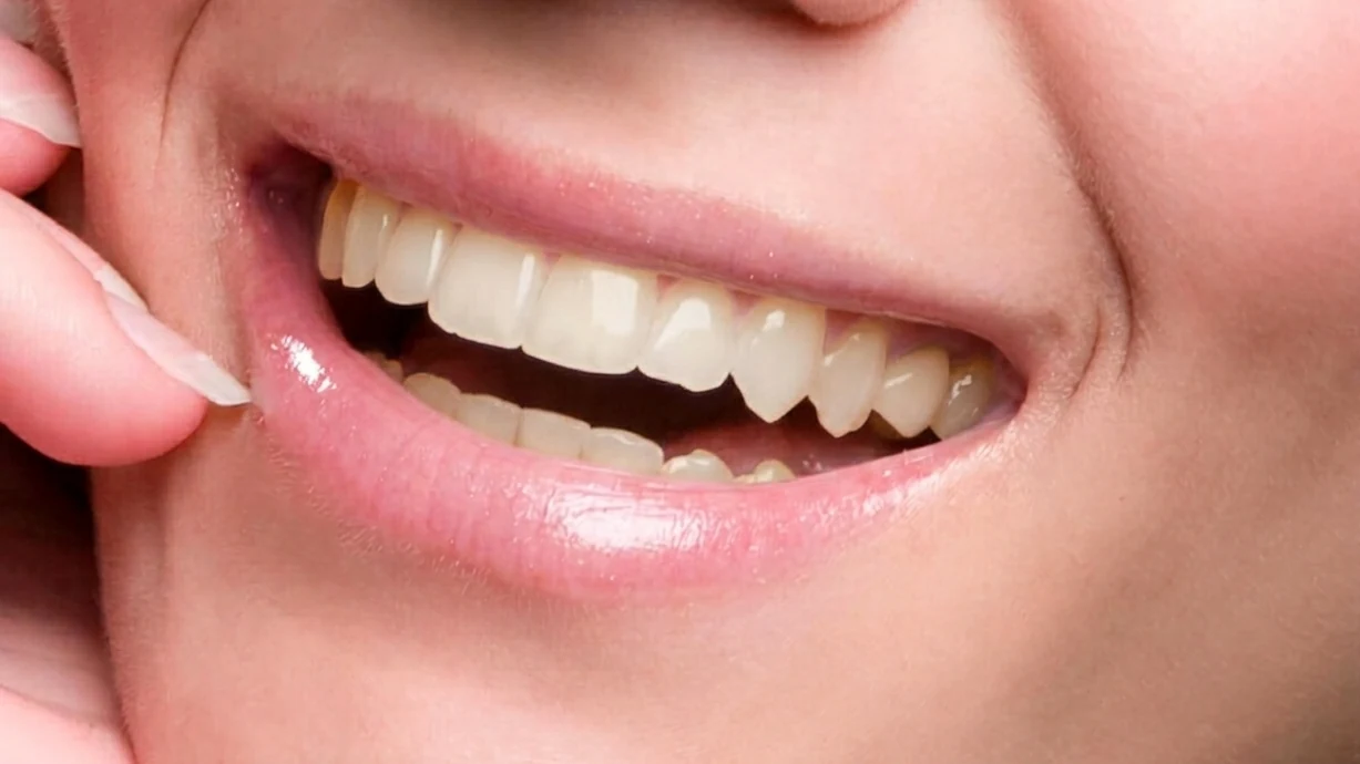 Avant blanchiment dentaire